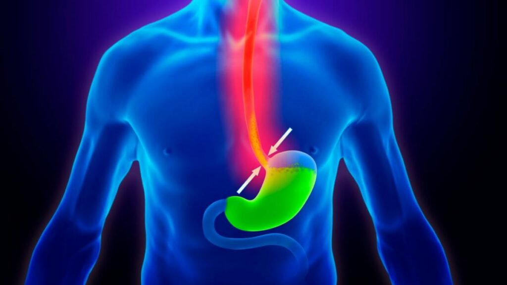 Reflujo gastroesofagico